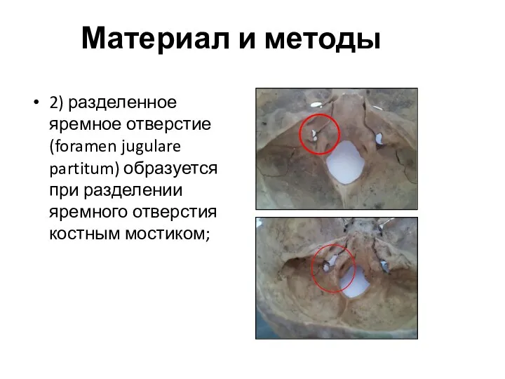 Материал и методы 2) разделенное яремное отверстие (foramen jugulare partitum) образуется при