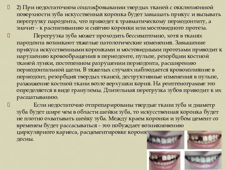 2) При недостаточном сошлифовывании твердых тканей с окклюзионной поверхности зуба искусственная коронка