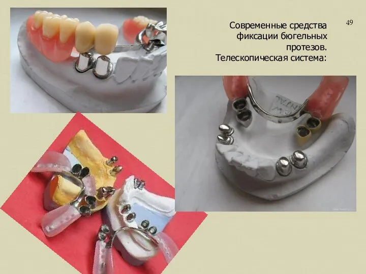 Современные средства фиксации бюгельных протезов. Телескопическая система: