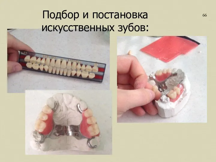 Подбор и постановка искусственных зубов: