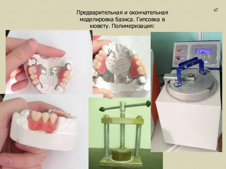 Предварительная и окончательная моделировка базиса. Гипсовка в кювету. Полимеризация: