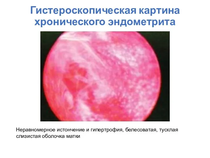 Гистероскопическая картина хронического эндометрита Неравномерное истончение и гипертрофия, белесоватая, тусклая слизистая оболочка матки