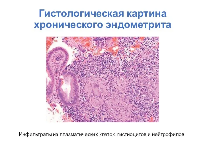 Гистологическая картина хронического эндометрита Инфильтраты из плазматических клеток, гистиоцитов и нейтрофилов