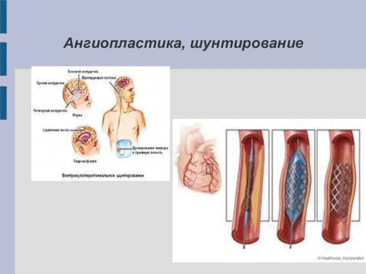 Ангиопластика, шунтирование