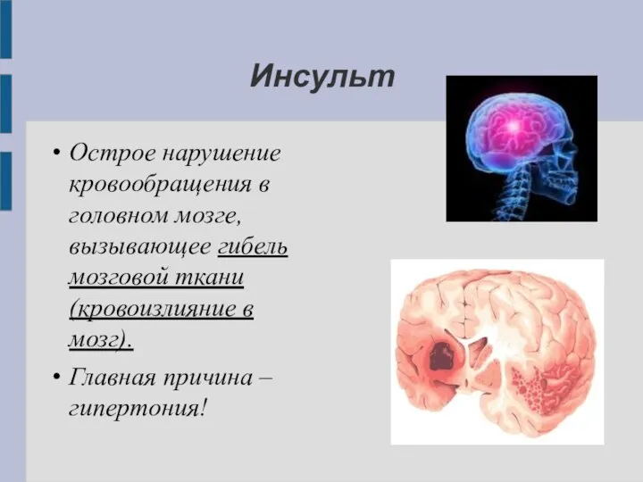 Инсульт Острое нарушение кровообращения в головном мозге, вызывающее гибель мозговой ткани (кровоизлияние