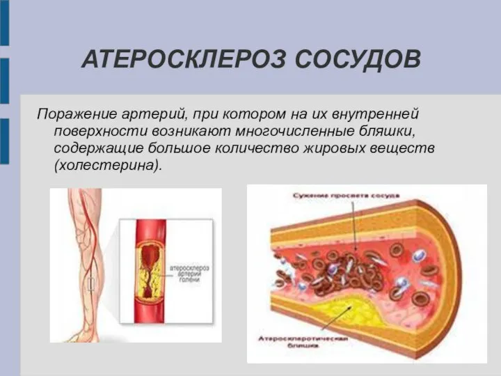 АТЕРОСКЛЕРОЗ СОСУДОВ Поражение артерий, при котором на их внутренней поверхности возникают многочисленные
