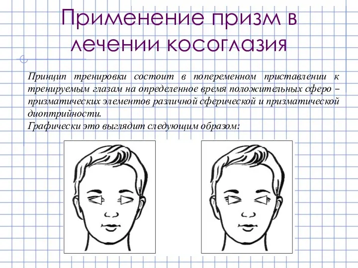 Применение призм в лечении косоглазия Принцип тренировки состоит в попеременном приставлении к