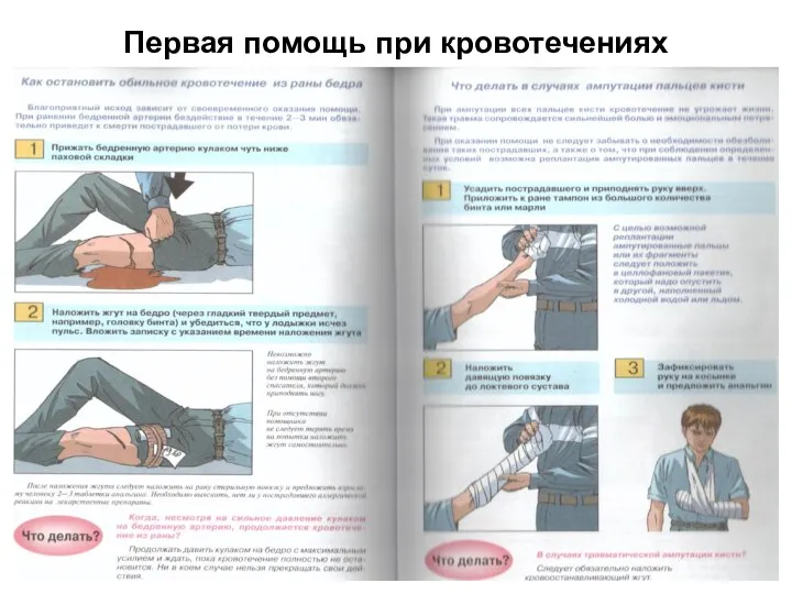 Первая помощь при кровотечениях