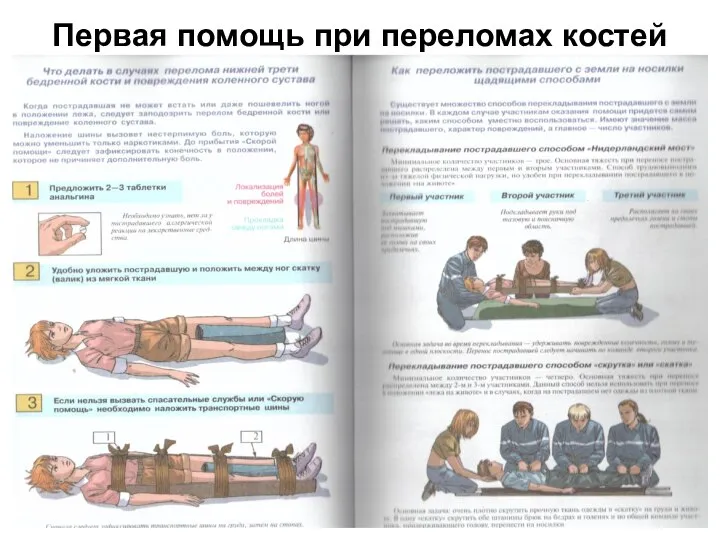 Первая помощь при переломах костей