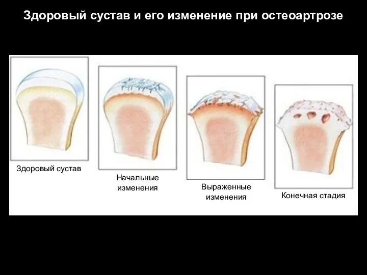 Здоровый сустав и его изменение при остеоартрозе Здоровый сустав Начальные изменения Выраженные изменения Конечная стадия