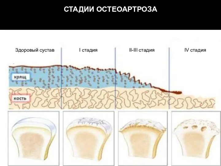 СТАДИИ ОСТЕОАРТРОЗА Здоровый сустав I стадия II-III стадия IV стадия