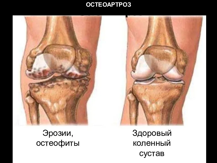ОСТЕОАРТРОЗ Эрозии, остеофиты Здоровый коленный сустав