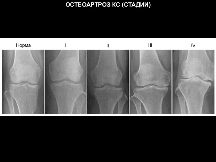 ОСТЕОАРТРОЗ КС (СТАДИИ) Норма I II III IV