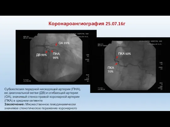 Коронароангиография 25.07.16г ОА 99% ПНА 99% ДВ 99% ПКА 60% ПКА 70%