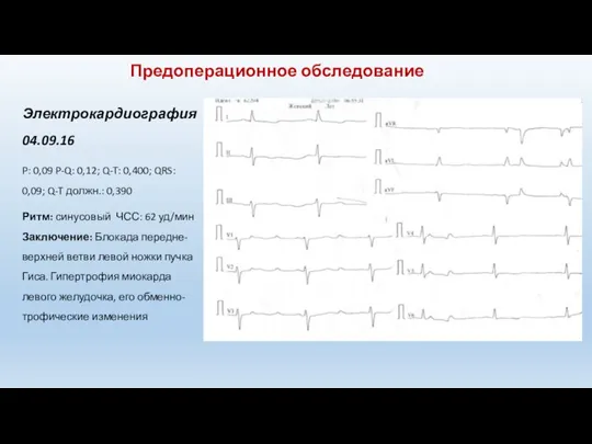 Электрокардиография 04.09.16 P: 0,09 P-Q: 0,12; Q-T: 0,400; QRS: 0,09; Q-T должн.: