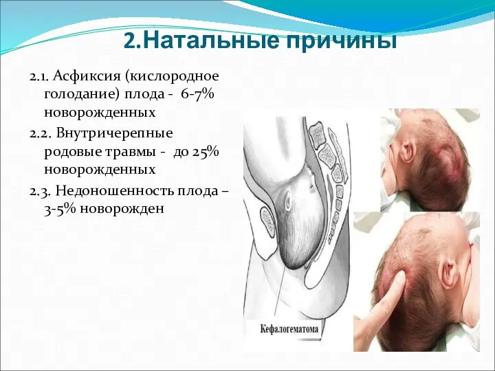 2.Натальные причины 2.1. Асфиксия (кислородное голодание) плода - 6-7% новорожденных 2.2. Внутричерепные