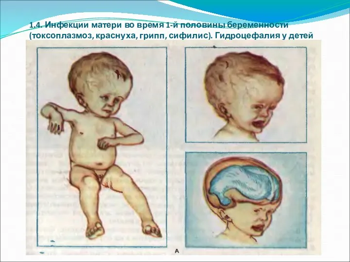 1.4. Инфекции матери во время 1-й половины беременности (токсоплазмоз, краснуха, грипп, сифилис). Гидроцефалия у детей