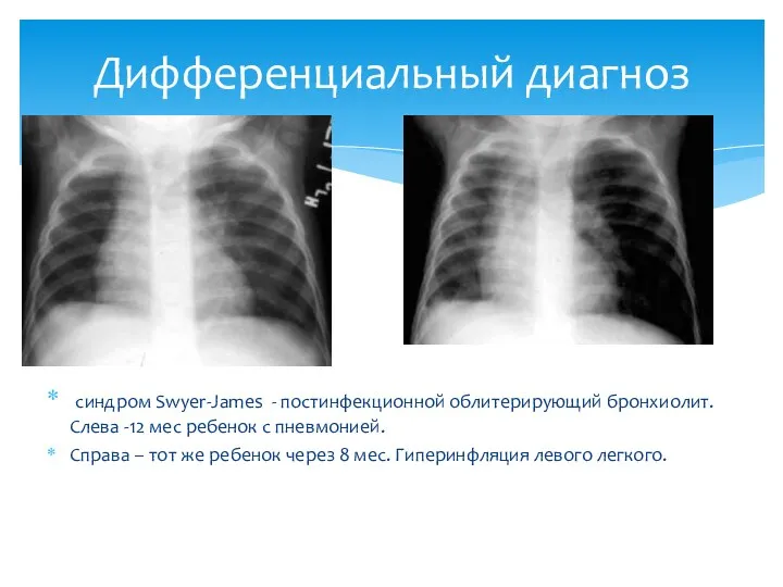 синдром Swyer-James - постинфекционной облитерирующий бронхиолит. Слева -12 мес ребенок с пневмонией.