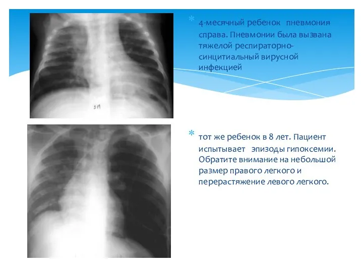 ‎4-месячный ребенок пневмония справа. Пневмонии была вызвана тяжелой респираторно-синцитиальный вирусной инфекцией‎ ‎тот