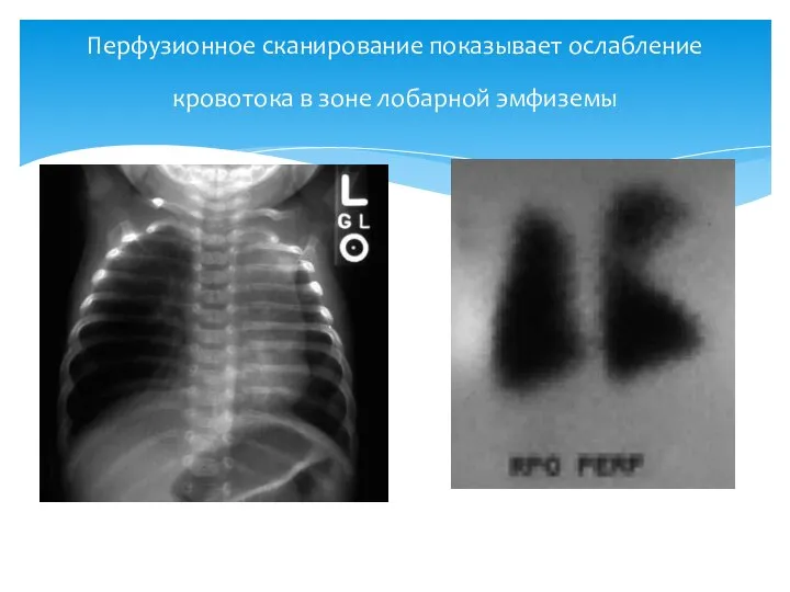 Перфузионное сканирование показывает ослабление кровотока в зоне лобарной эмфиземы