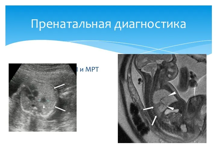 2 триместр УЗИ и МРТ Пренатальная диагностика