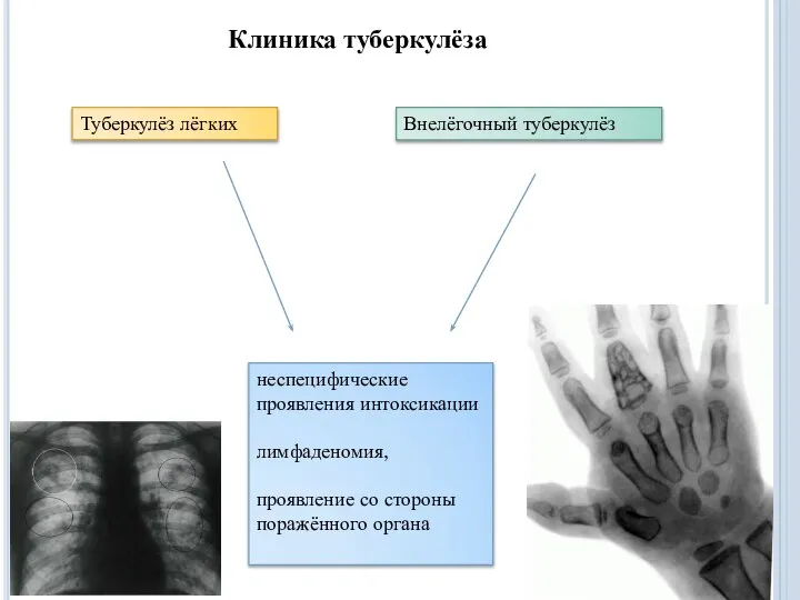 Клиника туберкулёза Туберкулёз лёгких Внелёгочный туберкулёз неспецифические проявления интоксикации лимфаденомия, проявление со стороны поражённого органа