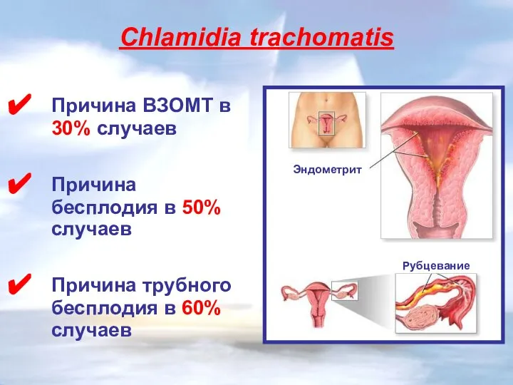 Сhlamidia trachomatis Причина ВЗОМТ в 30% случаев Причина бесплодия в 50% случаев