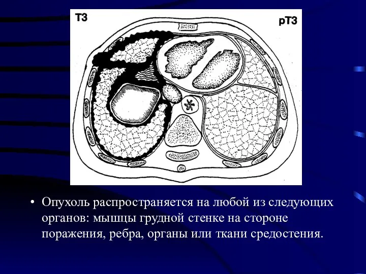 Опухоль распространяется на любой из следующих органов: мышцы грудной стенке на стороне