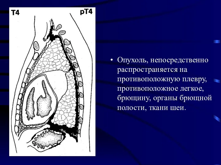 Опухоль, непосредственно распространяется на противоположную плевру, противоположное легкое, брющину, органы брющной полости, ткани шеи.