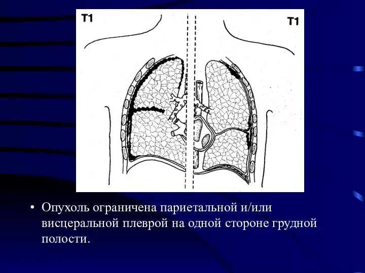 Опухоль ограничена париетальной и/или висцеральной плеврой на одной стороне грудной полости.
