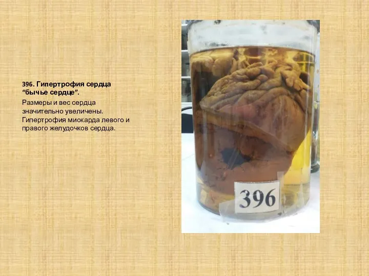 396. Гипертрофия сердца “бычье сердце”. Размеры и вес сердца значительно увеличены. Гипертрофия