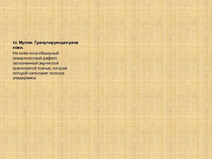 32. Муляж. Гранулирующая рана кожи. На коже носа обширный поверхностный дефект, заполненный