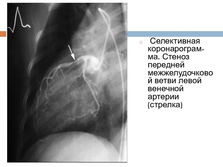 Селективная коронарограм-ма. Стеноз передней межжелудочковой ветви левой венечной артерии (стрелка)