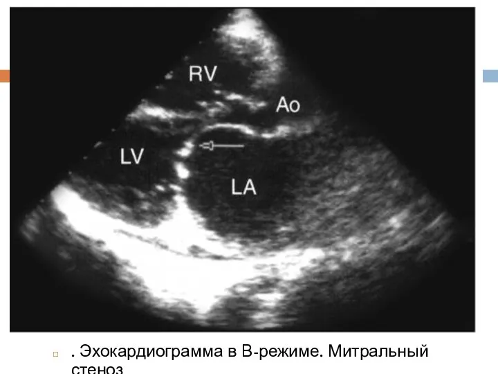 . Эхокардиограмма в В-режиме. Митральный стеноз
