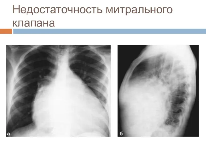 Недостаточность митрального клапана