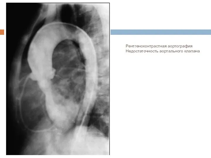Рентгеноконтрастная аортография Недостаточность аортального клапана