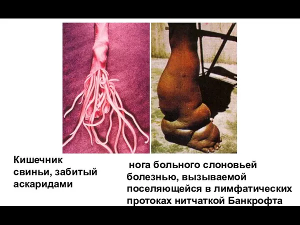 нога больного слоновьей болезнью, вызываемой поселяющейся в лимфатических протоках нитчаткой Банкрофта Кишечник свиньи, забитый аскаридами