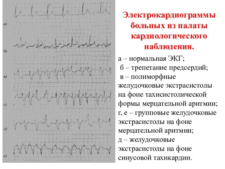 Электрокардиограммы больных из палаты кардиологического наблюдения. а – нормальная ЭКГ; б –