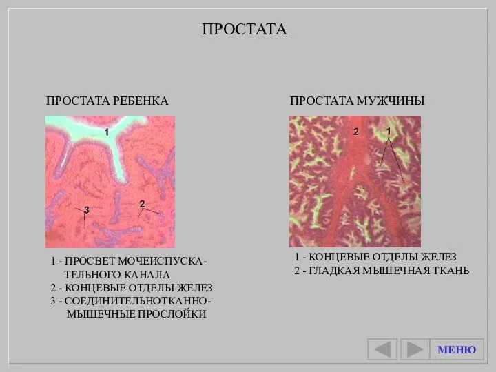 1 - ПРОСВЕТ МОЧЕИСПУСКА- ТЕЛЬНОГО КАНАЛА 2 - КОНЦЕВЫЕ ОТДЕЛЫ ЖЕЛЕЗ 3