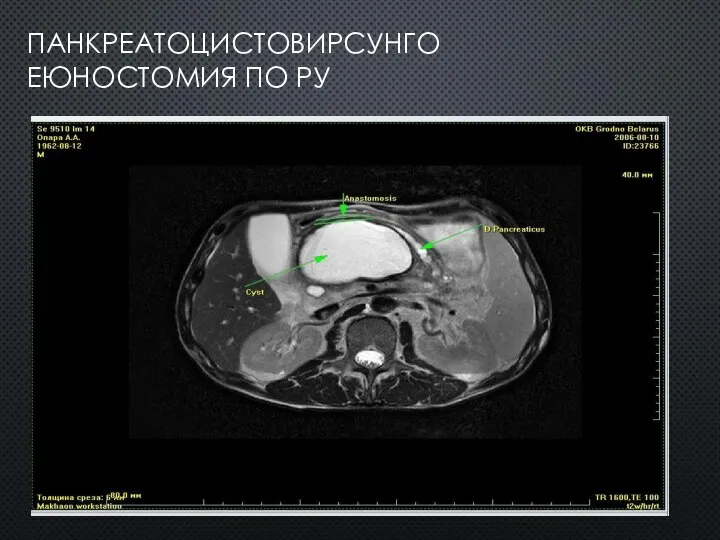 ПАНКРЕАТОЦИСТОВИРСУНГО ЕЮНОСТОМИЯ ПО РУ