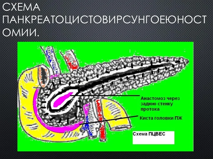 СХЕМА ПАНКРЕАТОЦИСТОВИРСУНГОЕЮНОСТОМИИ.