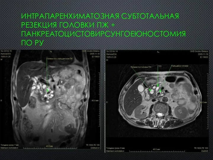 ИНТРАПАРЕНХИМАТОЗНАЯ СУБТОТАЛЬНАЯ РЕЗЕКЦИЯ ГОЛОВКИ ПЖ + ПАНКРЕАТОЦИСТОВИРСУНГОЕЮНОСТОМИЯ ПО РУ