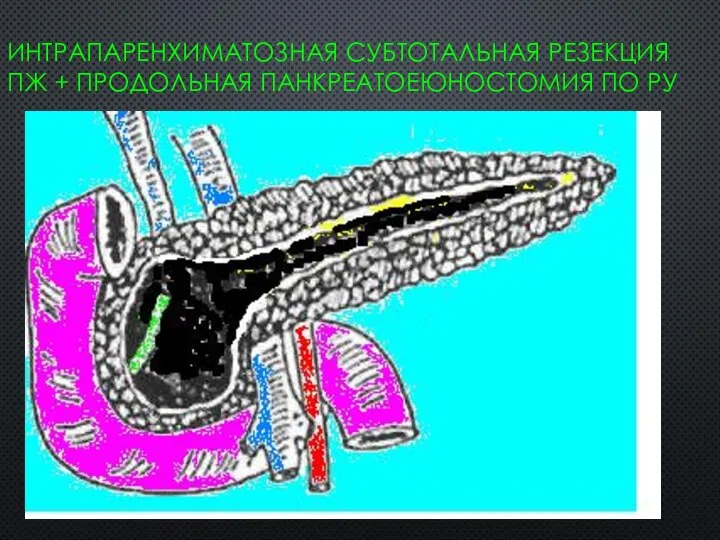 ИНТРАПАРЕНХИМАТОЗНАЯ СУБТОТАЛЬНАЯ РЕЗЕКЦИЯ ПЖ + ПРОДОЛЬНАЯ ПАНКРЕАТОЕЮНОСТОМИЯ ПО РУ