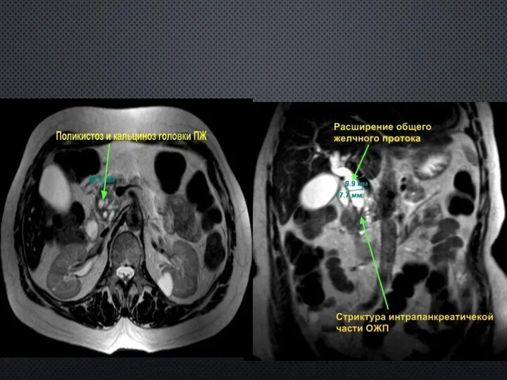 МРТ-грамма: поликистоз и кальциноз головки ПЖ в сочетании с панкреатической и биллиарной гипертензией