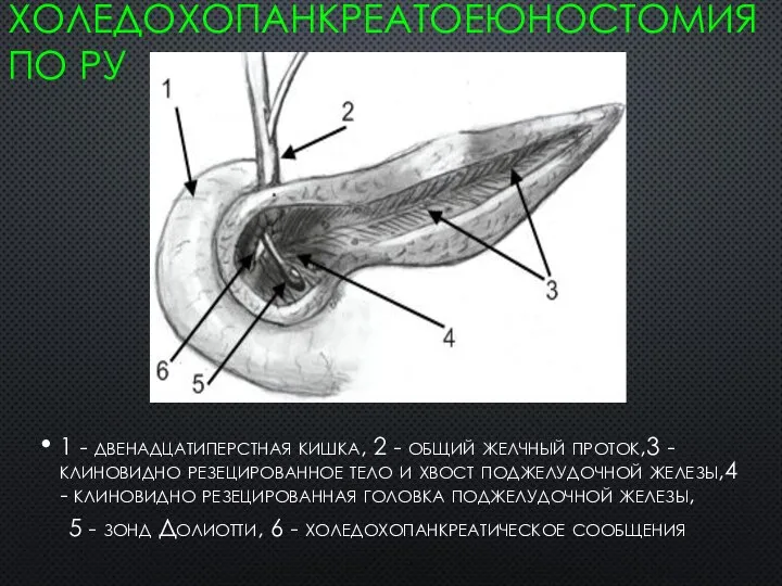 ХОЛЕДОХОПАНКРЕАТОЕЮНОСТОМИЯ ПО РУ 1 - двенадцатиперстная кишка, 2 - общий желчный проток,3