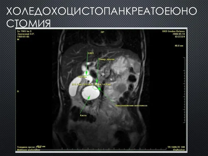 ХОЛЕДОХОЦИСТОПАНКРЕАТОЕЮНОСТОМИЯ