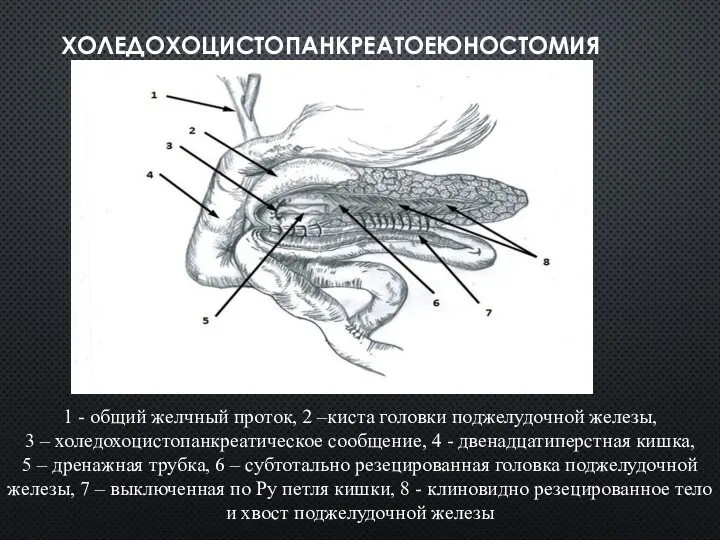 ХОЛЕДОХОЦИСТОПАНКРЕАТОЕЮНОСТОМИЯ 1 - общий желчный проток, 2 –киста головки поджелудочной железы, 3