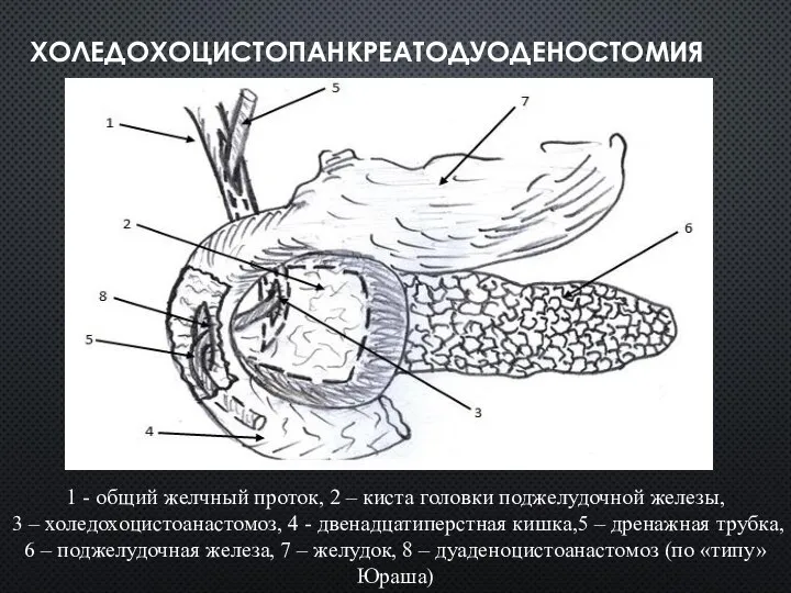 ХОЛЕДОХОЦИСТОПАНКРЕАТОДУОДЕНОСТОМИЯ 1 - общий желчный проток, 2 – киста головки поджелудочной железы,