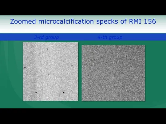 Zoomed microcalcification specks of RMI 156