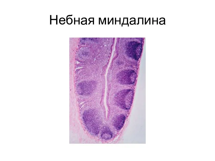 Небная миндалина